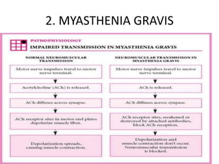 2. MYASTHENIA GRAVIS
 
