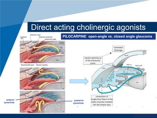 Direct acting cholinergic agonists 
PILOCARPINE open-angle vs. closed angle glaucoma 
www.company.com 
posterior 
synechiae 
anterior 
synechiae 
 