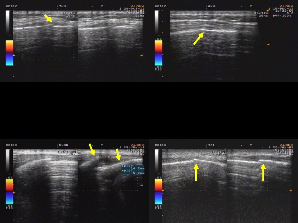 Chondral and Bony Rib Fracture in Relevation by Ultrasound