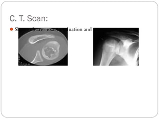 C. T. Scan:
Shows clearer exact evaluation and extent.
 