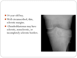 14-year-old boy.
Well-circumscribed, thin,
sclerotic margins.
 Chondroblastomas may have
sclerotic, nonsclerotic, or
in...