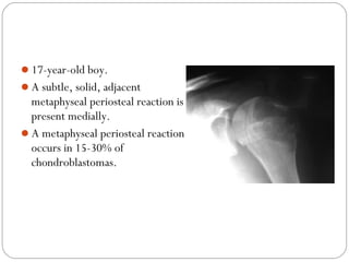 17-year-old boy.
A subtle, solid, adjacent
metaphyseal periosteal reaction is
present medially.
A metaphyseal periostea...