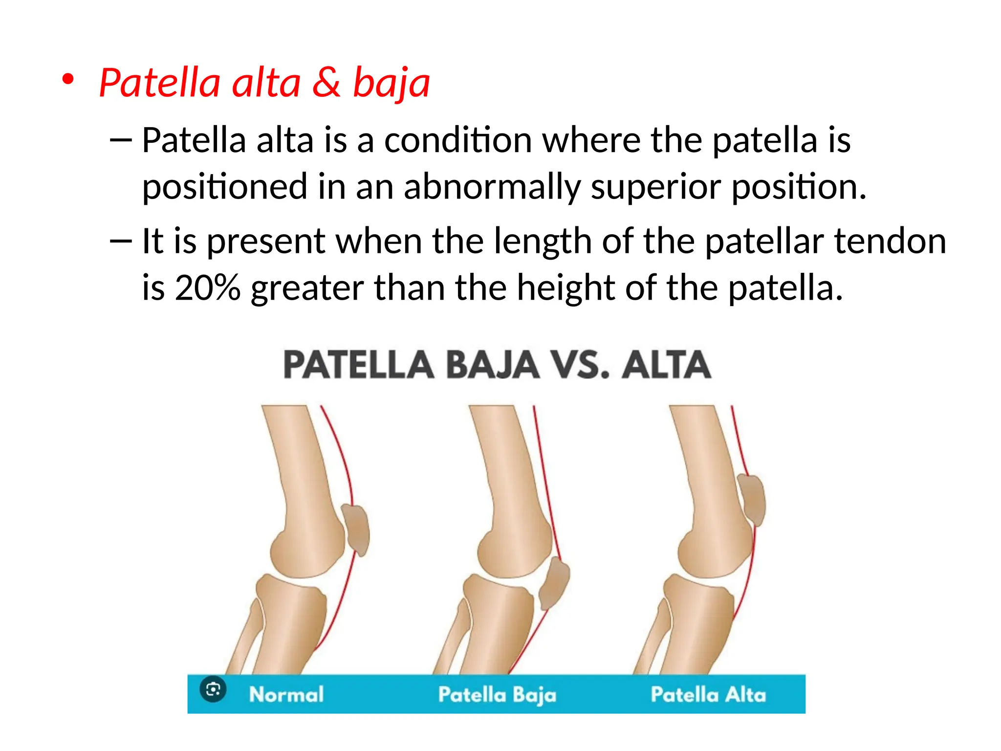 PHYSIOTHERAPY MANAGEMENT FOR CHONDROMALACIA PATELLA.pptx