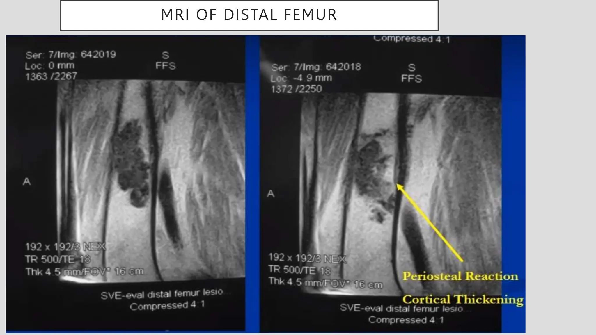 MRI OF DISTAL FEMUR
 