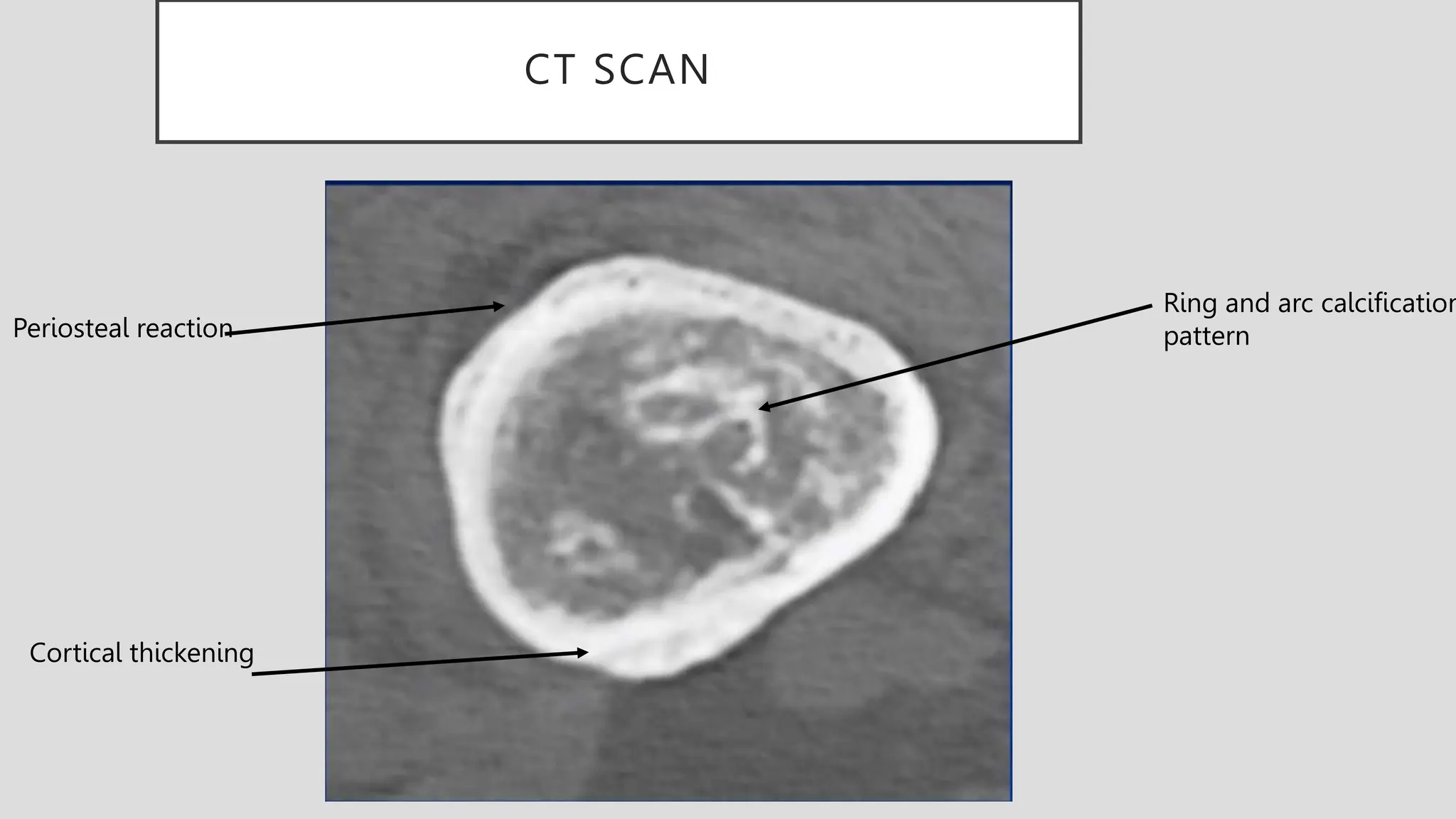 CT SCAN
Ring and arc calcification
pattern
Cortical thickening
Periosteal reaction
 