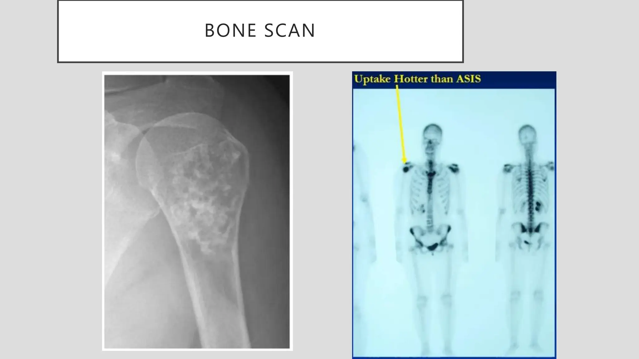 BONE SCAN
 
