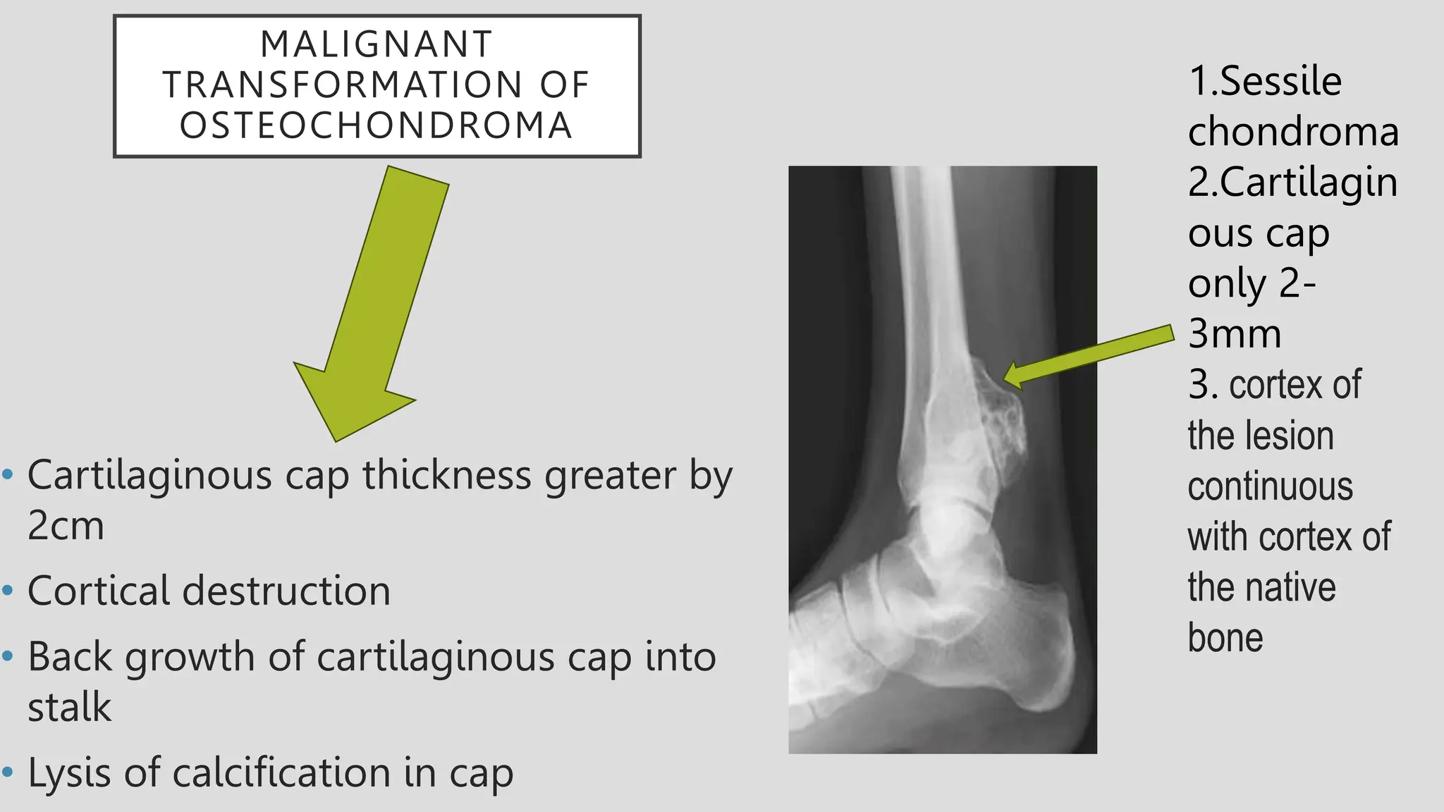 MALIGNANT
TRANSFORMATION OF
OSTEOCHONDROMA
• Cartilaginous cap thickness greater by
2cm
• Cortical destruction
• Back growth of cartilaginous cap into
stalk
• Lysis of calcification in cap
1.Sessile
chondroma
2.Cartilagin
ous cap
only 2-
3mm
3. cortex of
the lesion
continuous
with cortex of
the native
bone
 