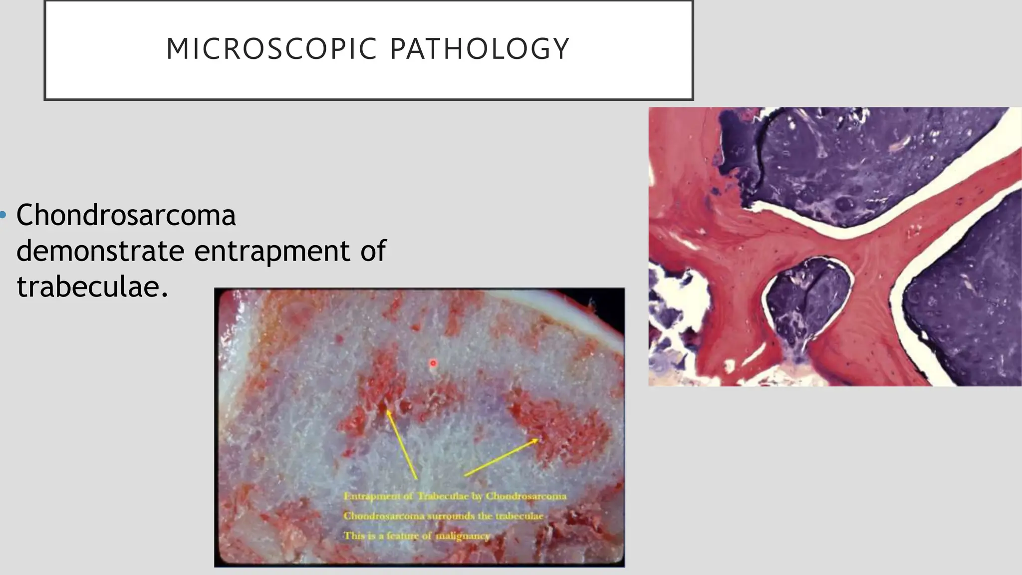 MICROSCOPIC PATHOLOGY
• Chondrosarcoma
demonstrate entrapment of
trabeculae.
 