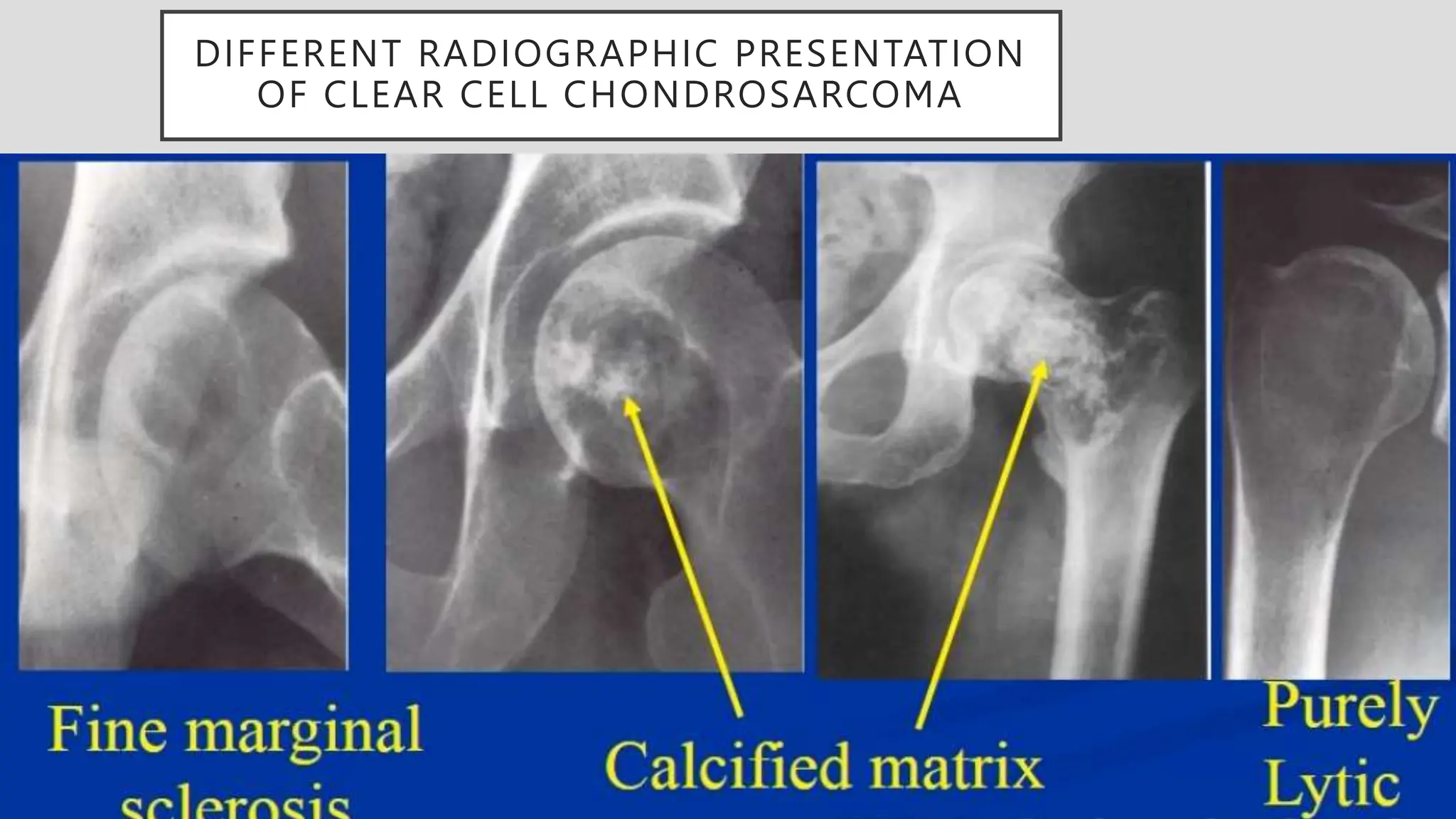 DIFFERENT RADIOGRAPHIC PRESENTATION
OF CLEAR CELL CHONDROSARCOMA
 