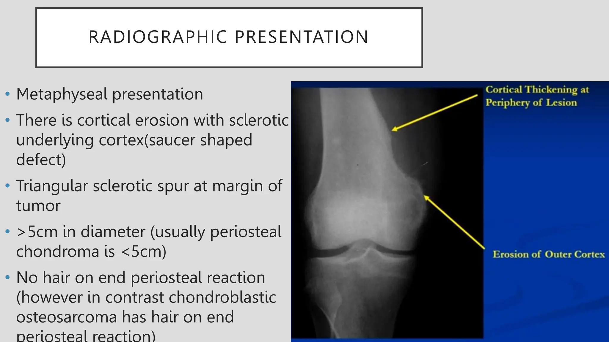 RADIOGRAPHIC PRESENTATION
• Metaphyseal presentation
• There is cortical erosion with sclerotic
underlying cortex(saucer shaped
defect)
• Triangular sclerotic spur at margin of
tumor
• >5cm in diameter (usually periosteal
chondroma is <5cm)
• No hair on end periosteal reaction
(however in contrast chondroblastic
osteosarcoma has hair on end
 