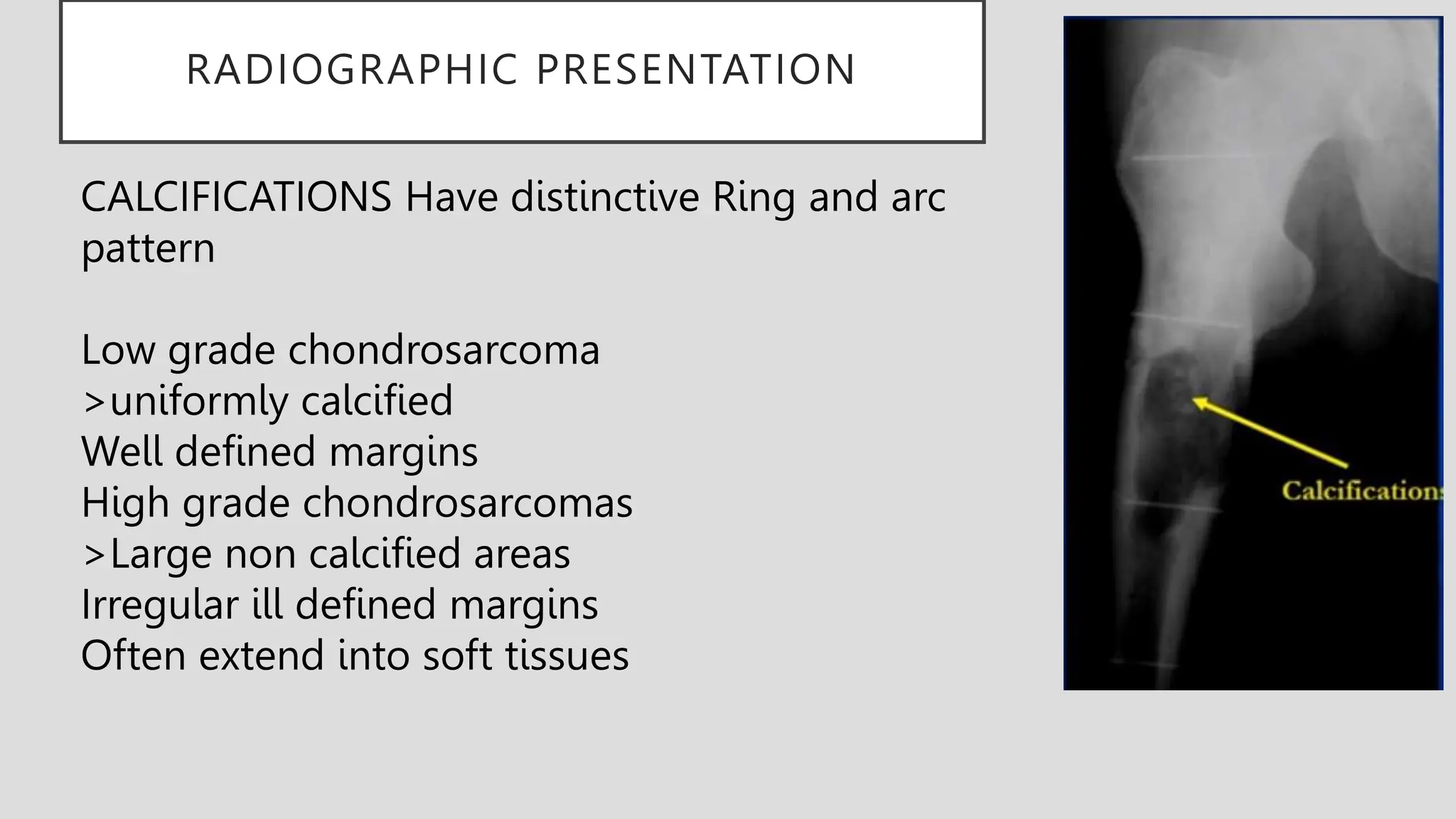 RADIOGRAPHIC PRESENTATION
CALCIFICATIONS Have distinctive Ring and arc
pattern
Low grade chondrosarcoma
>uniformly calcified
Well defined margins
High grade chondrosarcomas
>Large non calcified areas
Irregular ill defined margins
Often extend into soft tissues
 