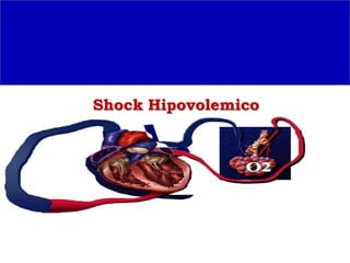 Shock Hipovolemico 
 