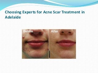 Choosing Experts for Acne Scar Treatment in
Adelaide
 