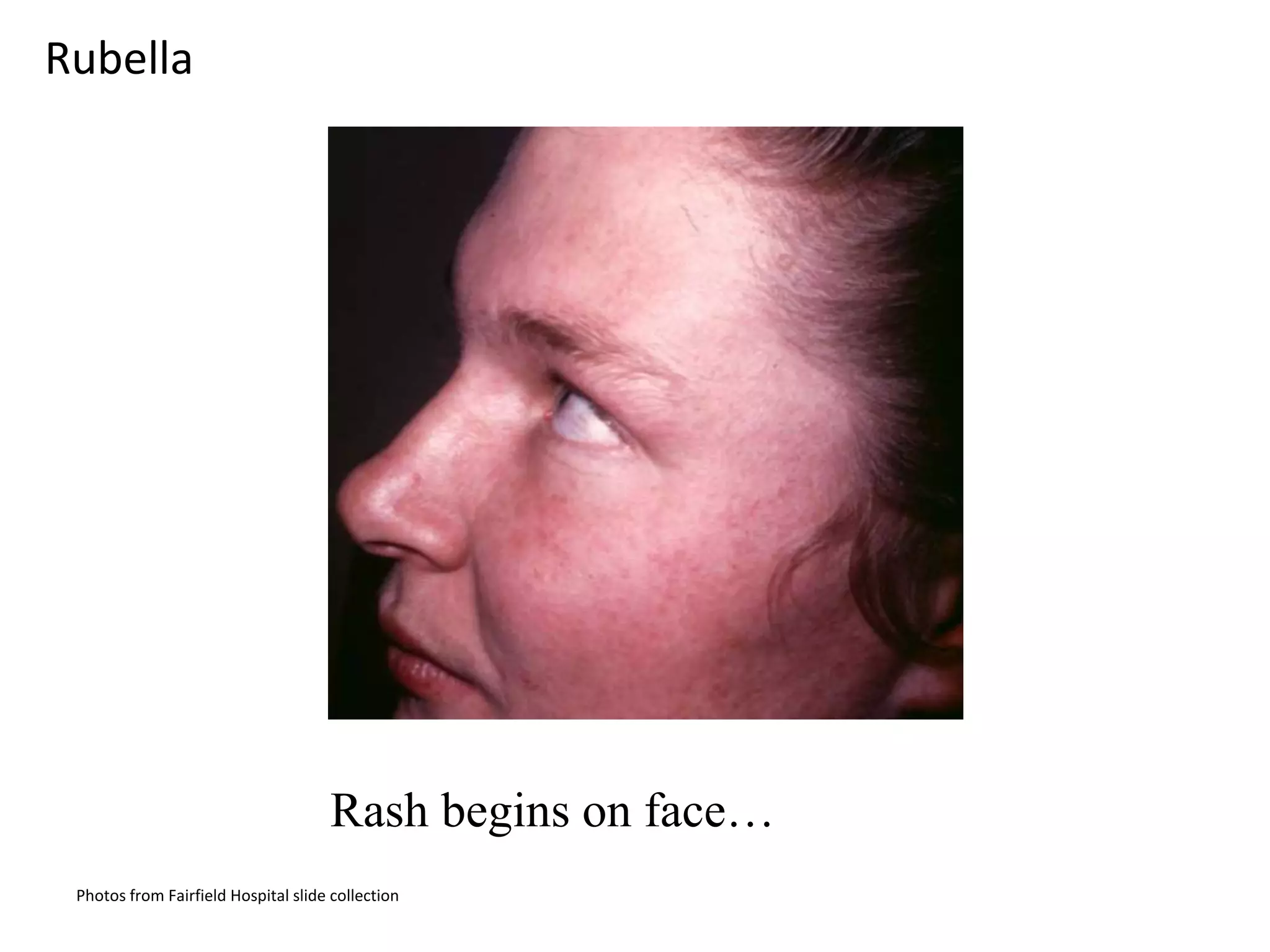 Rash begins on face…
Rubella
Photos from Fairfield Hospital slide collection
 