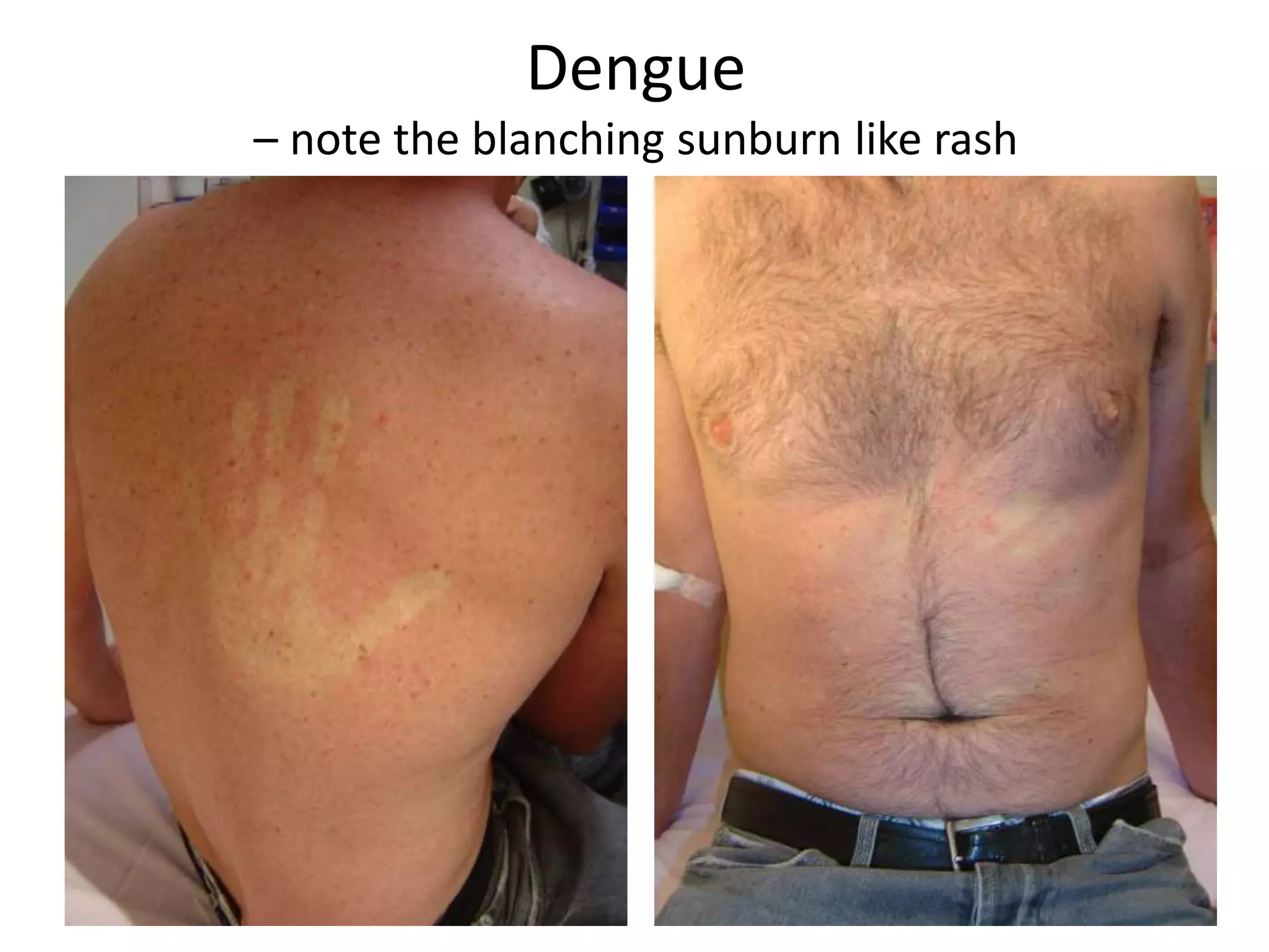 1179838
Dengue
– note the blanching sunburn like rash
 