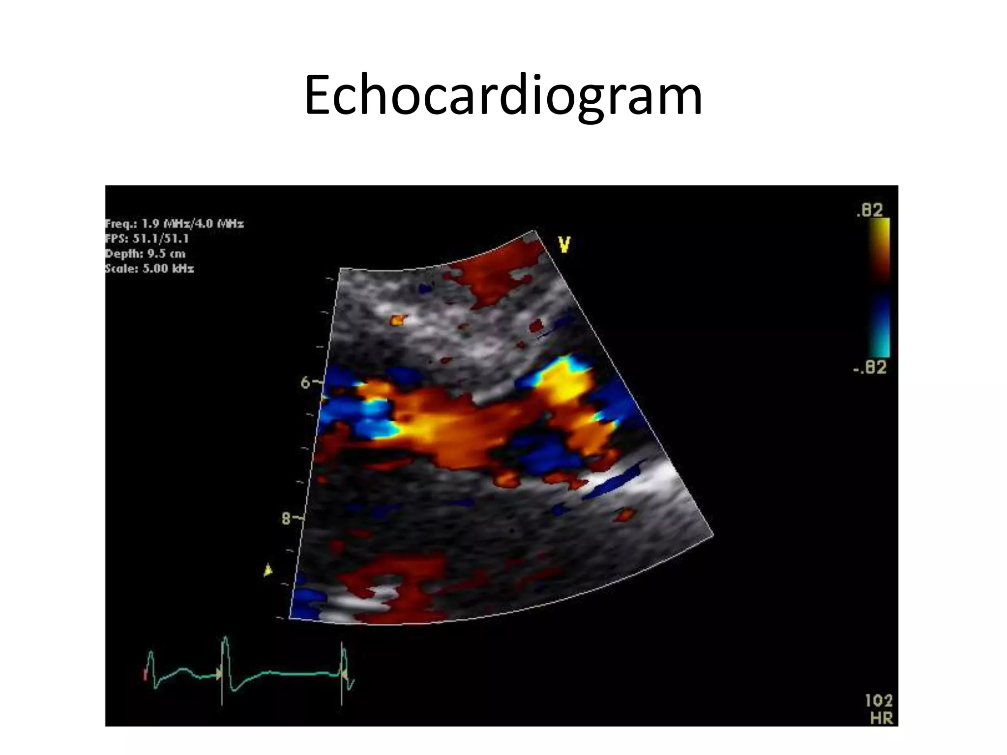 Echocardiogram
 