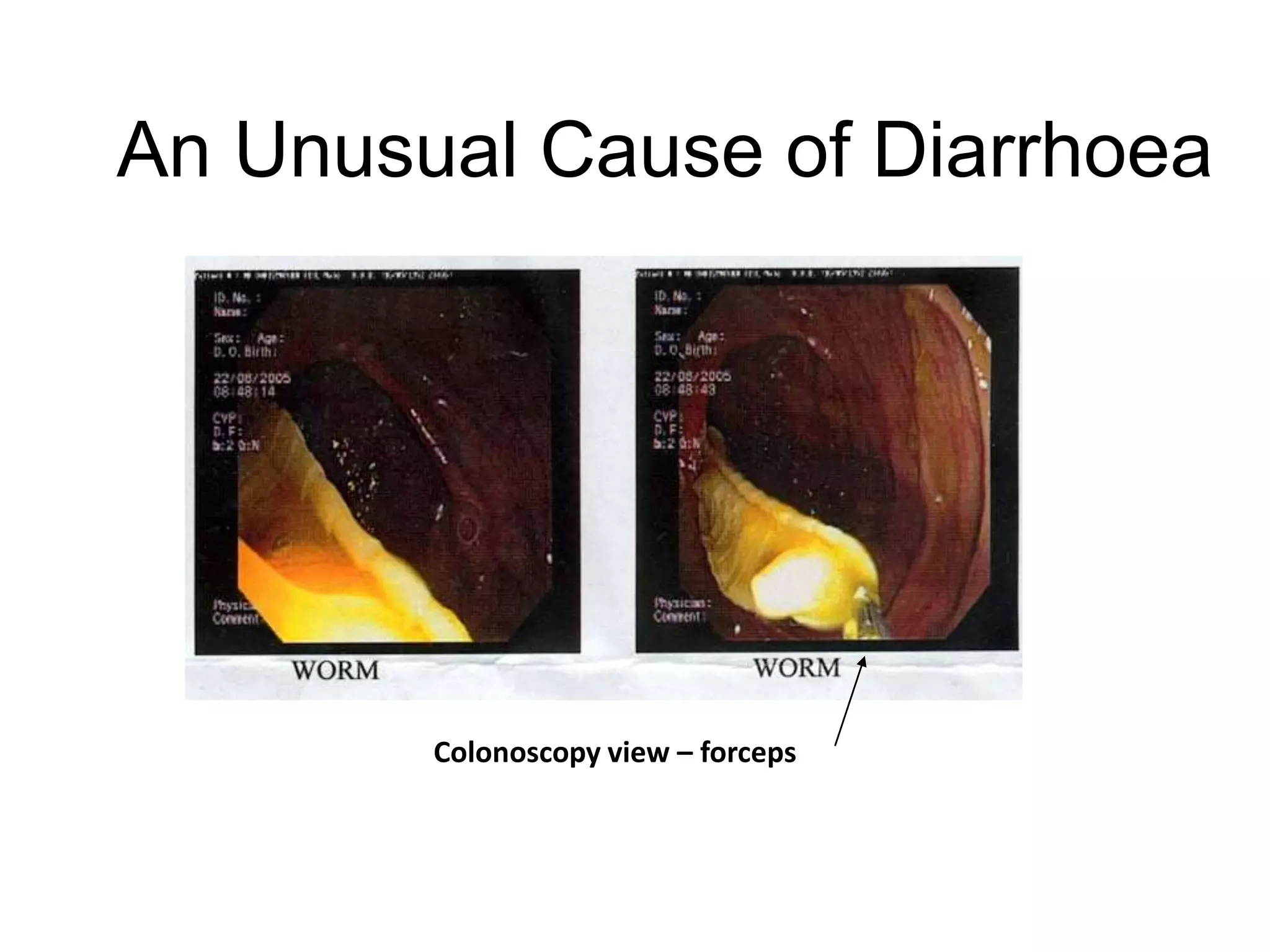 An Unusual Cause of Diarrhoea
Colonoscopy view – forceps
 