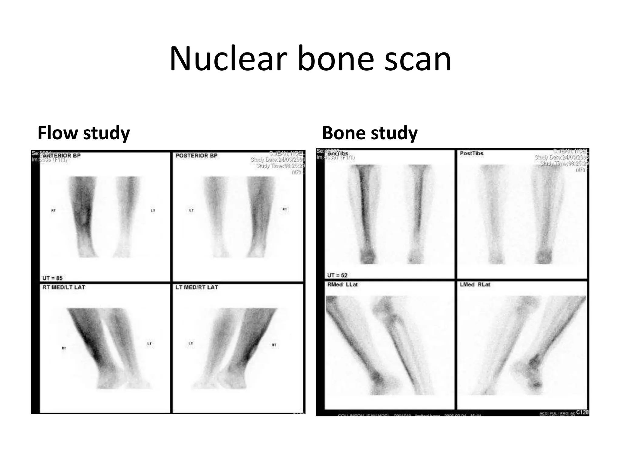 Nuclear bone scan
Flow study Bone study
 