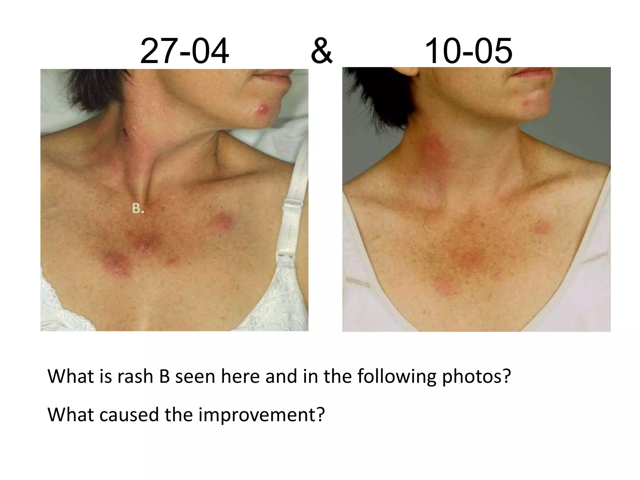 27-04 & 10-05
B.
What is rash B seen here and in the following photos?
What caused the improvement?
 
