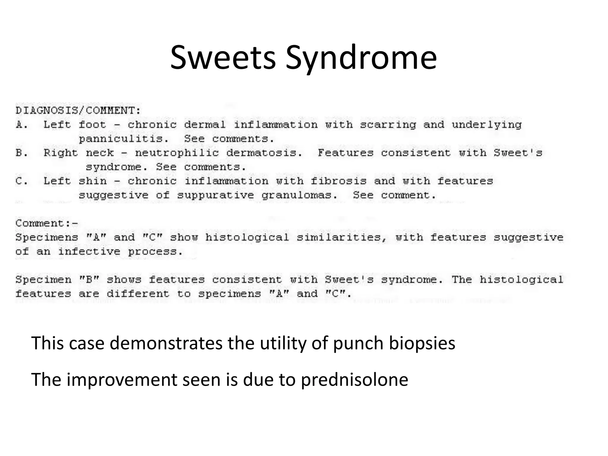 Sweets Syndrome
This case demonstrates the utility of punch biopsies
The improvement seen is due to prednisolone
 