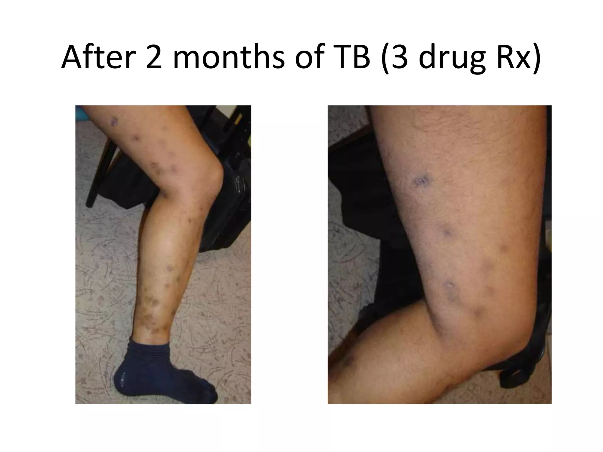 After 2 months of TB (3 drug Rx)
 