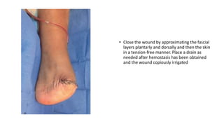 Chopart amputation | PPTX