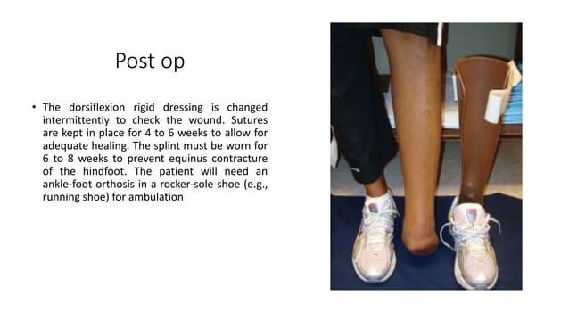 Chopart amputation | PPTX