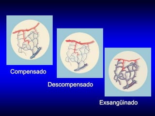 Compensado

             Descompensado


                             Exsangüinado
 