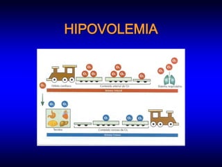 HIPOVOLEMIA
 