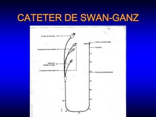 CATETER DE SWAN-GANZ
 