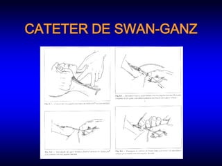 CATETER DE SWAN-GANZ
 