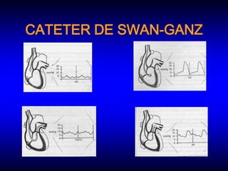 CATETER DE SWAN-GANZ
 
