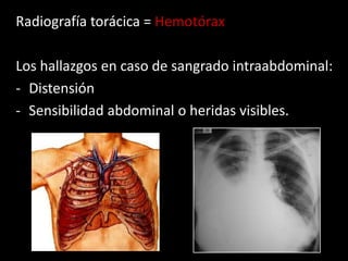 Radiografía torácica = Hemotórax
Los hallazgos en caso de sangrado intraabdominal:
- Distensión
- Sensibilidad abdominal o heridas visibles.

 