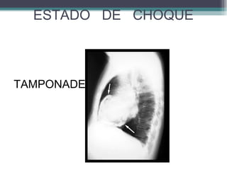 TAMPONADE
ESTADO DE CHOQUE
 