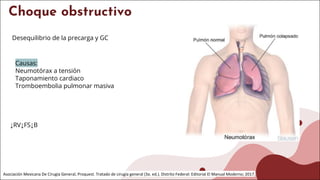 Choque obstructivo
Desequilibrio de la precarga y GC
Asociación Mexicana De Cirugía General, Proquest. Tratado de cirugía general (3a. ed.). Distrito Federal: Editorial El Manual Moderno; 2017.
Causas:
Neumotórax a tensión
Taponamiento cardiaco
Tromboembolia pulmonar masiva
↓RV↓FS↓B
 