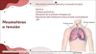 Neumotórax
a tensión
Aire entra a cavidad pleural y no puede escapar
Genera:
Colapso pulmonar,
Elevación de la presión intrapleural
Desviación del mediastino hacia el lado contralateral
↓RV
Asociación Mexicana De Cirugía General, Proquest. Tratado de cirugía general (3a. ed.). Distrito Federal: Editorial El Manual Moderno; 2017.
 