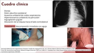 Cuadro clínico
Disnea
Dolor pleurítico ipsilateral
Ausencia unilateral de ruidos respiratorios
Hiperresonancia unilateral a la percusión
Ingurgitación yugular
Desviación de la tráquea hacia el lado contralateral
Tratamiento: descompresión inmediata con aguja
Asociación Mexicana De Cirugía General, Proquest. Tratado de cirugía general (3a. ed.). Distrito Federal: Editorial El Manual Moderno; 2017.
Porcel JM. Neumotórax espontáneo. Medicina Integral [Internet]. 2001 Jun 1;38(1):3–7. Available from: https://www.elsevier.es/es-revista-medicina-integral-63-articulo-
neumotorax-espontaneo-13015301
 