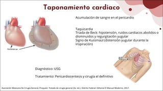 Taponamiento cardiaco
Acumulación de sangre en el pericardio
Taquicardia
Triada de Beck: hipotensión, ruidos cardiacos abolidos o
disminuidos y regurgitación yugular
Signo de Kussmaul (distensión yugular durante la
inspiración)
Asociación Mexicana De Cirugía General, Proquest. Tratado de cirugía general (3a. ed.). Distrito Federal: Editorial El Manual Moderno; 2017.
Diagnóstico: USG
Tratamiento: Pericardiocentesis y cirugía el definitivo
 