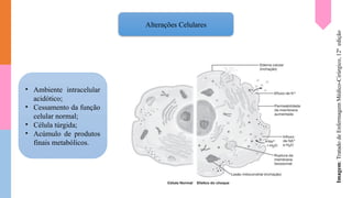 Alterações Celulares
• Ambiente intracelular
acidótico;
• Cessamento da função
celular normal;
• Célula túrgida;
• Acúmulo de produtos
finais metabólicos.
Imagem:
Tratado
de
Enfermagem
Médico-Cirúrgico,
12ª
edição
 