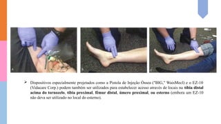  Dispositivos especialmente projetados como a Pistola de Injeção Óssea ("BIG," WaisMecl) e o EZ-10
(Vidacare Corp.) podem também ser utilizados para estabelecer acesso através de locais na tíbia distal
acima do tornozelo, tíbia proximal, fêmur distal, úmero proximal, ou esterno (embora um EZ-10
não deva ser utilizado no local do esterno).
 