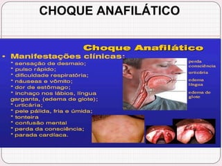 CHOQUE ANAFILÁTICO
 
