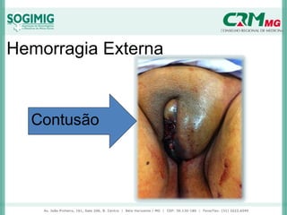Hemorragia Externa
Contusão
 