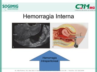 Hemorragia Interna
Hemorragia
Intraperitoneal
 