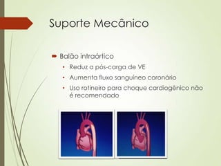 Suporte Mecânico
 Balão intraórtico
• Reduz a pós-carga de VE
• Aumenta fluxo sanguíneo coronário
• Uso rotineiro para choque cardiogênico não
é recomendado

 