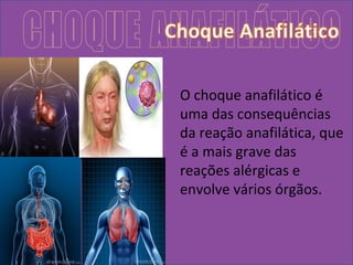 O choque anafilático é 
uma das consequências 
da reação anafilática, que 
é a mais grave das 
reações alérgicas e 
envolve vários órgãos. 
 
