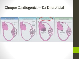 Choque Cardiógenico –Dx Diferencial 
 