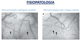 FISIOPATOLOGIA
Microcirculação sublingual saudável Microcirculação subl. choque séptico
 