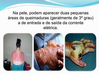 Na pele, podem aparecer duas pequenas
áreas de queimaduras (geralmente de 3º grau)
a de entrada e de saída da corrente
elétrica.
 