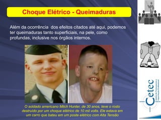Além da ocorrência dos efeitos citados até aqui, podemos
ter queimaduras tanto superficiais, na pele, como
profundas, inclusive nos órgãos internos.
Choque Elétrico - Queimaduras
O soldado americano Mitch Hunter, de 30 anos, teve o rosto
destruído por um choque elétrico de 10 mil volts. Ele estava em
um carro que bateu em um poste elétrico com Alta Tensão
 