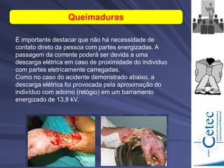 É importante destacar que não há necessidade de
contato direto da pessoa com partes energizadas. A
passagem da corrente poderá ser devida a uma
descarga elétrica em caso de proximidade do individuo
com partes eletricamente carregadas.
Como no caso do acidente demonstrado abaixo, a
descarga elétrica foi provocada pela aproximação do
indivíduo com adorno (relógio) em um barramento
energizado de 13,8 kV.
Queimaduras
 